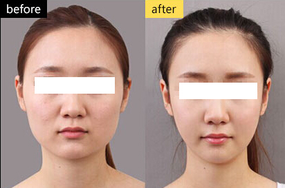 注射瘦臉針瘦臉價格詳解，全面了解瘦臉針費用及注意事項